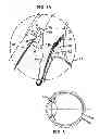 Fig. 04 - Ocular collar stent for treating narrowing of the irideocorneal angle
