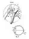 Fig. 06 - Ocular collar stent for treating narrowing of the irideocorneal angle