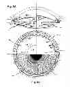 Fig. 10 - Ocular collar stent for treating narrowing of the irideocorneal angle