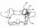 Fig. 01 - Facet joint replacement