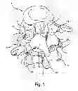 Fig. 02 - Facet joint replacement
