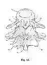 Fig. 03 - Facet joint replacement