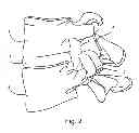 Fig. 04 - Facet joint replacement