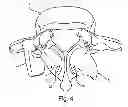 Fig. 06 - Facet joint replacement