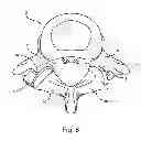 Fig. 08 - Facet joint replacement