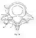 Fig. 16 - Facet joint replacement