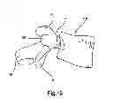 Fig. 20 - Facet joint replacement