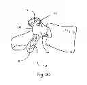Fig. 22 - Facet joint replacement