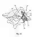 Fig. 34 - Facet joint replacement