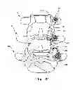 Fig. 35 - Facet joint replacement