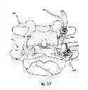 Fig. 40 - Facet joint replacement