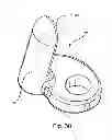 Fig. 41 - Facet joint replacement