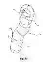 Fig. 43 - Facet joint replacement