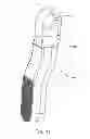 Fig. 44 - Facet joint replacement