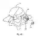 Fig. 45 - Facet joint replacement