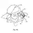 Fig. 46 - Facet joint replacement