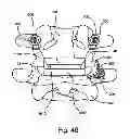 Fig. 49 - Facet joint replacement