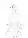 Fig. 12 - Spinal stabilization system and method