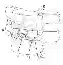 Fig. 01 - Interbody fusion device