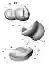 Fig. 02 - Total knee replacement substituting function of anterior cruciate ligament
