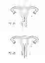 Fig. 03 - Intrauterine contraceptive device