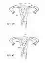 Fig. 07 - Intrauterine contraceptive device