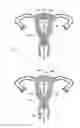 Fig. 04 - Intrauterine contraceptive device