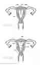 Fig. 07 - Intrauterine contraceptive device
