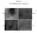 Fig. 20 - Treatment of tumors with recombinant interferon alpha