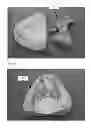 Fig. 03 - Modeling and manufacturing the superstructure for a denture