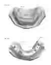 Fig. 07 - Modeling and manufacturing the superstructure for a denture