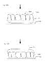 Fig. 19 - Modeling and manufacturing the superstructure for a denture