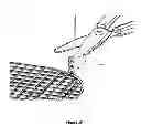 Fig. 09 - Fixating means between a mesh and mesh deployment means especially useful for hernia repair surgeries and methods thereof