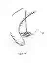 Fig. 11 - Fixating means between a mesh and mesh deployment means especially useful for hernia repair surgeries and methods thereof