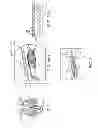 Fig. 02 - Method and device for treating dysfunctional cardiac tissue