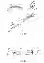 Fig. 07 - Method and device for treating dysfunctional cardiac tissue