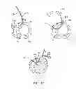 Fig. 09 - Method and device for treating dysfunctional cardiac tissue