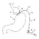 Fig. 01 - LAPAROSCOPIC GASTRIC BAND WITH ACTIVE AGENTS