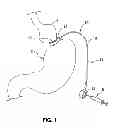 Fig. 02 - LAPAROSCOPIC GASTRIC BAND WITH ACTIVE AGENTS