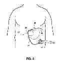 Fig. 04 - LAPAROSCOPIC GASTRIC BAND WITH ACTIVE AGENTS