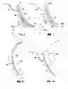 Fig. 06 - LAPAROSCOPIC GASTRIC BAND WITH ACTIVE AGENTS