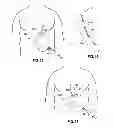 Fig. 09 - LAPAROSCOPIC GASTRIC BAND WITH ACTIVE AGENTS