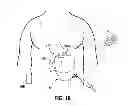 Fig. 11 - LAPAROSCOPIC GASTRIC BAND WITH ACTIVE AGENTS