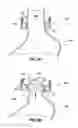 Fig. 04 - SELF-ADJUSTING GASTRIC BAND