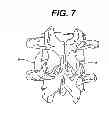 Fig. 06 - Configured and sized cannula