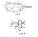 Fig. 04 - RECTAL BALLOON WITH SENSOR CABLE