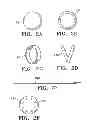 Fig. 04 - SUBCUTANEOUS CAVITY MARKING DEVICE AND METHOD