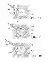 Fig. 07 - SUBCUTANEOUS CAVITY MARKING DEVICE AND METHOD