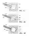 Fig. 08 - SUBCUTANEOUS CAVITY MARKING DEVICE AND METHOD