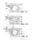 Fig. 09 - SUBCUTANEOUS CAVITY MARKING DEVICE AND METHOD
